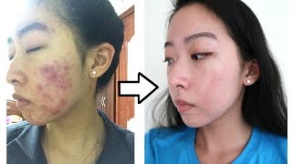 How I Cleared My Acne with ONE Product NO ACCUTANE [upl. by Eustasius633]