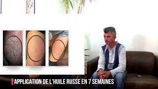 20 ans de souffrances causés par le psoriasis  Comment Agostino sen est débarrassé [upl. by Publus336]