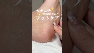 【足の角質ケア】久しぶりにした…😅フットケア 足裏 足裏ケア footcare 足裏角質ケア 角質 スキンケアボディケア [upl. by Mellette]