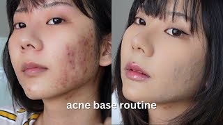 acne skin ʚɞ ༘⋆ acne coverage base routine  cover acne easily with makeup [upl. by Thibaut]