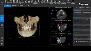 LargeV Dental Analysis Software How LargeV Al makes automatic maxillary sinus analysis [upl. by Hoxsie291]