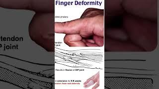 mallet finger deformitythephysiodoctoranatomyphysiotharapisthumananatomymotivationbiology [upl. by Elttil]