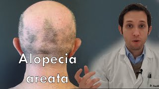 🔴 CALVICIE o ALOPECIA ANDROGENETICA ¡CAUSAS y TRATAMIENTOS drapilarochoa Dermatologa [upl. by Emrich]