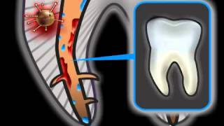 Root Canal Complications in Dentistry [upl. by Aihsek]