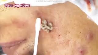 Big Cystic Acne Blackheads ExtractionBlackheads amp Milia Whiteheads Removal Pimple Popping [upl. by Vlad703]