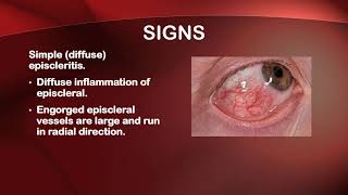 EPISCLERITIS I OPHTHALMOLOGY [upl. by Notyalk316]