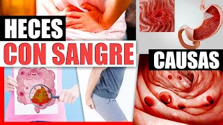 Sangre En Las Heces  Causas Y Tratamiento Natural Para Hemorroides Diverticulitis Ulceras Y Mas [upl. by Lukasz]