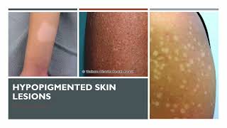 Hypopigmented Skin Lesions [upl. by Hurless]