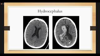 Intracerebral Hemorrhage  Neurology [upl. by Robinett756]