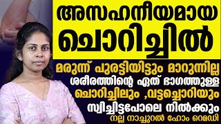 വട്ടച്ചൊറിയും ചൊറിച്ചിലും മാറ്റാൻ നല്ല നാച്ചുറൽ ഹോം റെമഡി ഇതാChorichil Maattaan [upl. by Olaznog823]