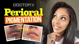 Doctor V  Perioral Pigmentation  Skin Of Colour  Brown Or Black Skin [upl. by Festa58]