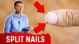 Whats Lacking With Split Nails [upl. by Grimaldi820]