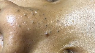 Big Cystic Acne Blackheads Extraction Blackheads amp Milia Whiteheads Removal Pimple Popping  1074 [upl. by Caruso]