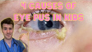 Causes of Red Eye  Part 1 SUBCONJUNCTIVAL HAEMORRHAGE blood on the eyeball [upl. by Bertie]