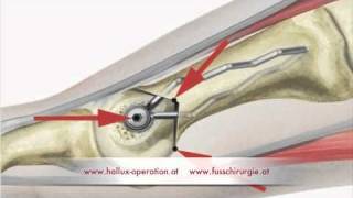 Hallux Operation nach Stoffella Teil 23 Osteotomie [upl. by Atse]