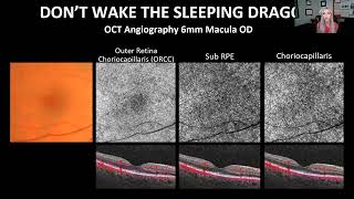 Mastering OCT Interpretation Through Case Analysis [upl. by Karli]