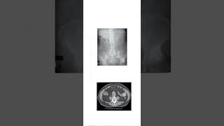 Case number 6 riglers Triad Look at the description for viva questionsviva casestudyradiology [upl. by Yenattirb]