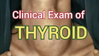 Clinical Examination of Thyroid [upl. by Amaryllis826]