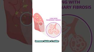 Idiopathic Pulmonary Fibrosis IPF Explained pulmonaryfibrosis lungdisease lungs [upl. by Erasme]