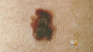 Melanoma Monday Puts Deadliest Form Of Skin Cancer In The Spotlight [upl. by Meri]