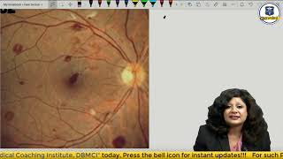 Ophthalmology Rewind  Fundus Pathologies NEET PG Preparation [upl. by Vevay]