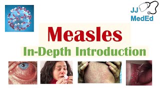 Measles Outbreak Everything You Need to Know in 90 Seconds [upl. by Bethena]