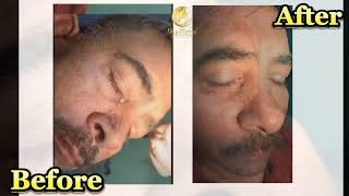 Sebaceous cyst surgery  Skin Planet Clinic  Nagpur [upl. by Ahsinuq315]