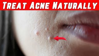 5 Tips to Avoid and Treat Acne Naturally [upl. by Aivat]