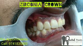 zirconia crown metal free crowns  smile designing [upl. by Uv]