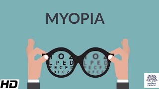 Myopia Signs and Symptoms Causes Diagnosis and Treatment [upl. by Assenyl192]