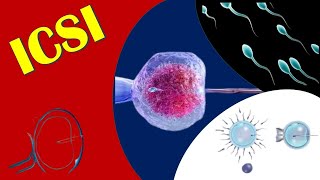 ICSI  Intracytoplasmic Sperm Injection [upl. by Aidam529]