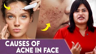 Faceல இங்க acne வந்தா இதான் காரணம் Dr Radha Subramaniyan  Causes of acne in face [upl. by Moser640]