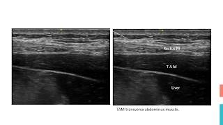 TAP Block Subcostal [upl. by Enytsirhc]