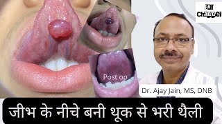 जीभ के नीचे बनी थूक से भरी थैली। Mucus retention cyst of tongue [upl. by Ignacius]