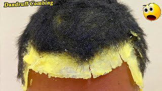 DRY SCALP  Big Flakes Dandruff Scratching Satisfying Video 784 [upl. by Naitsirhc]