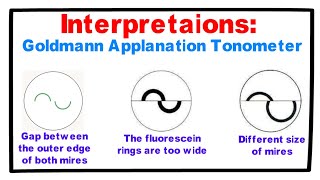 Interpretations Goldmann Applanation Tonometer [upl. by Thanh]