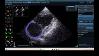 IQ 306 AFI LA ECHOPAC ANALYSIS HEPATOMA PTE ECHOCARDIOGRAPHY 2 [upl. by Carbo]