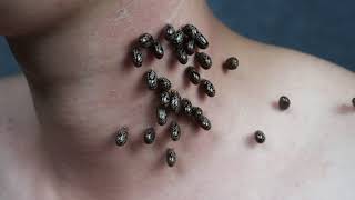 surgery to remove ticks from the neck [upl. by Samled]