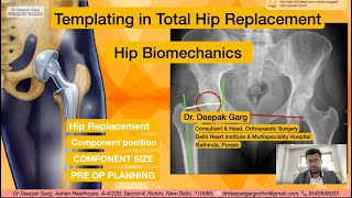 MASTERING PRE OPERATIVE TEMPLATING IN TOTAL HIP REPLACEMENT SURGERY  Dr Deepak Garg [upl. by Jaworski356]