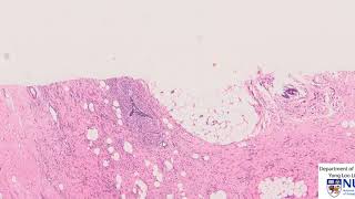 Breast Lobular carcinoma histology [upl. by Alliehs140]