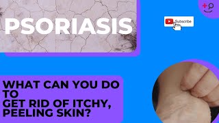 Psoriasis Treatments for You Get Rid of That Itchy Painful Rash [upl. by Uht]