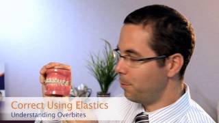 The Common Causes and Solutions to Overbites  Beecroft Orthodontics [upl. by Nnuahs]