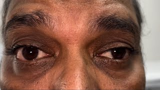 Myasthenia Gravis eye signs [upl. by Elatan]