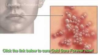 Cold Sore Free Forever Review  Cold Sore Remedies [upl. by Eelame]