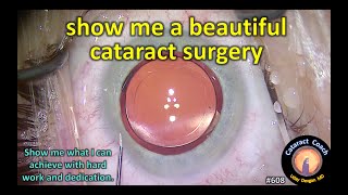 show me a beautiful cataract surgery [upl. by Lilybelle]