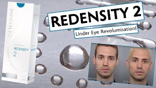 Redensity 2 For Under Eye Revolumisation [upl. by Odab]