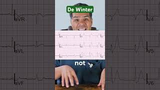 Recognizing De Winter Pattern A Critical ECG Sign of LAD Occlusion [upl. by Stephan]