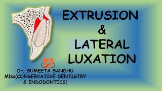 Extrusion and lateral luxation of teeth  Management Luxation injuries [upl. by Corey736]