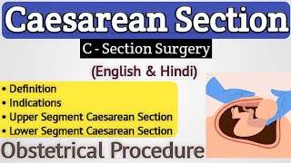 Cesarean section in hindi  Lower segment caesarean section in hindi [upl. by Toland]