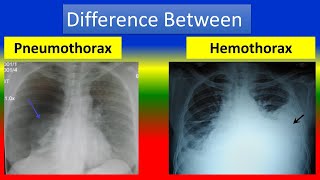 Difference between Pneumothorax and Hemothorax [upl. by Erline]